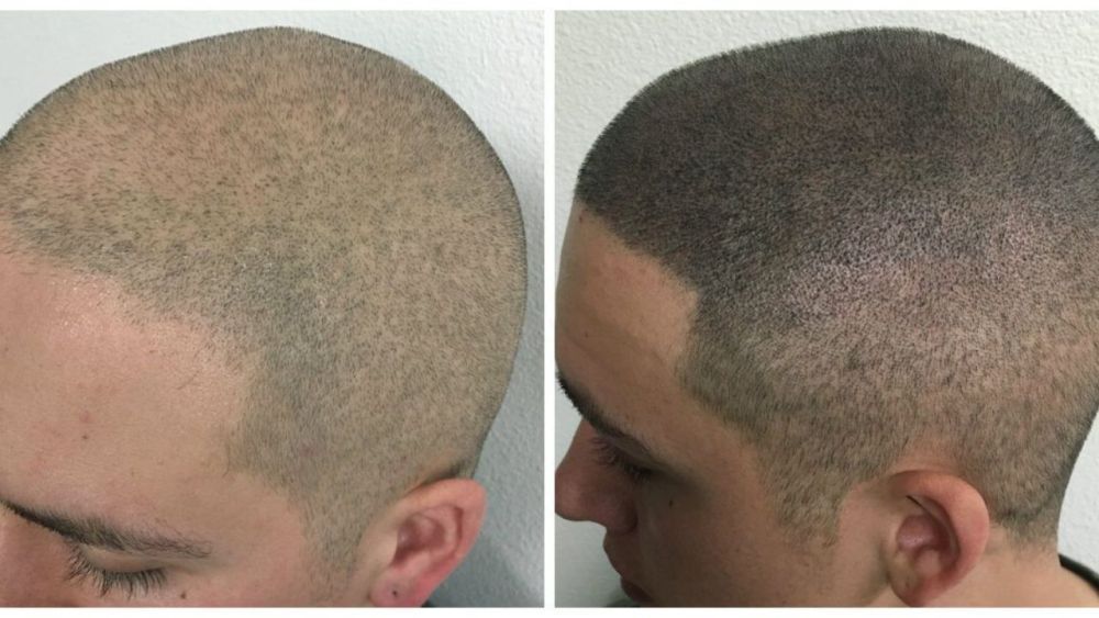 hair-scalp-micropigmentation-for-thinning-hair-natural-look-big-0