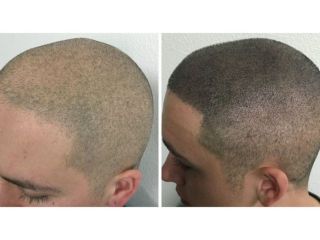 hair-scalp-micropigmentation-for-thinning-hair-natural-look-small-0
