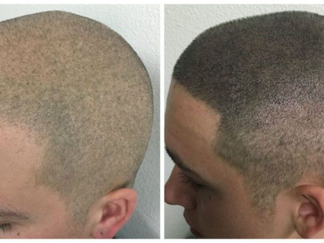 hair-scalp-micropigmentation-for-thinning-hair-natural-look