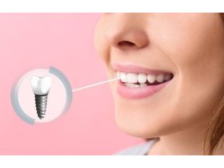 top-clinics-offering-best-seattle-dental-implants-services-small-0
