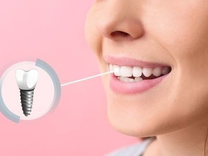 top-clinics-offering-best-seattle-dental-implants-services