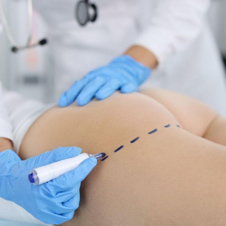 butt-implants-for-women-lift-and-enhance-body-shape-big-0