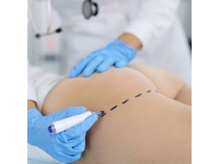 butt-implants-for-women-lift-and-enhance-body-shape-small-0