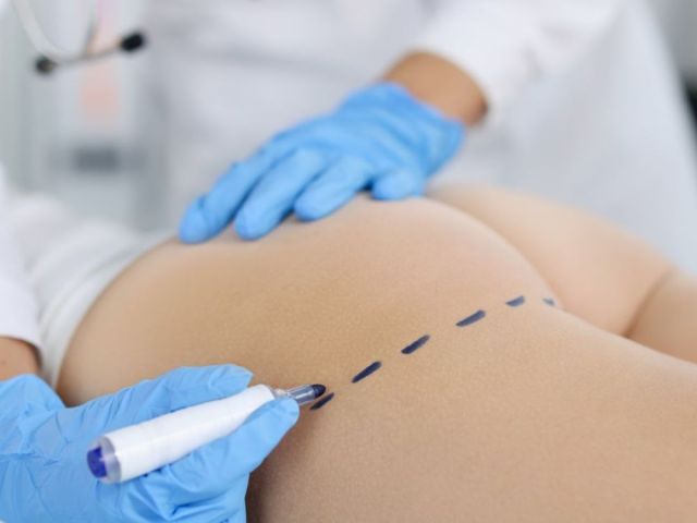 butt-implants-for-women-lift-and-enhance-body-shape