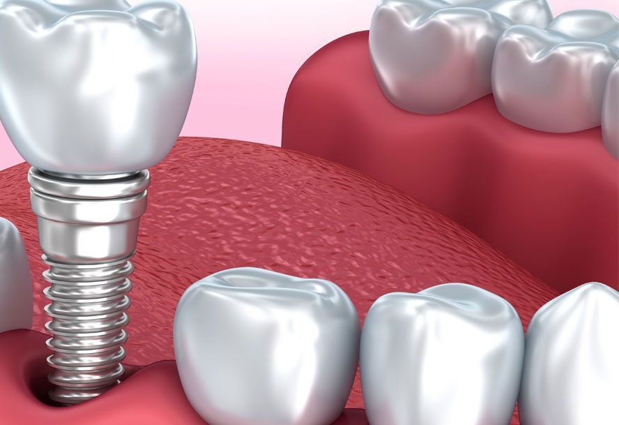 expert-dental-implants-in-cumming-ga-big-0