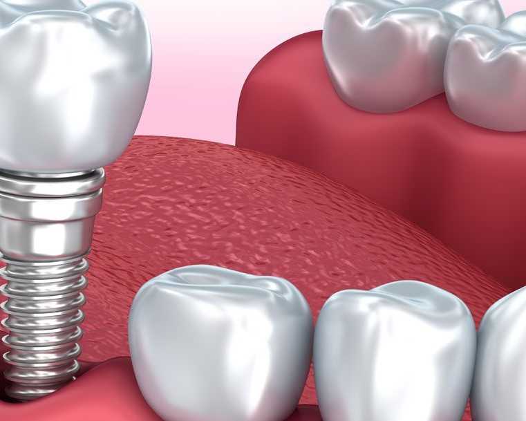 expert-dental-implants-in-cumming-ga