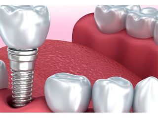 expert-dental-implants-in-cumming-ga-small-0