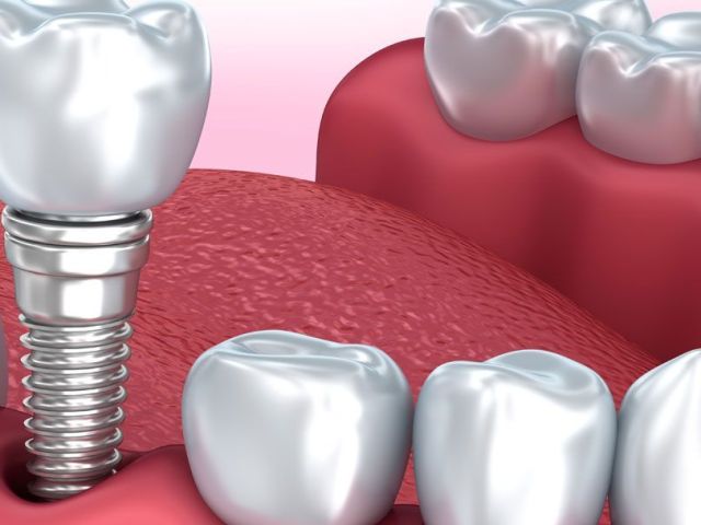 expert-dental-implants-in-cumming-ga