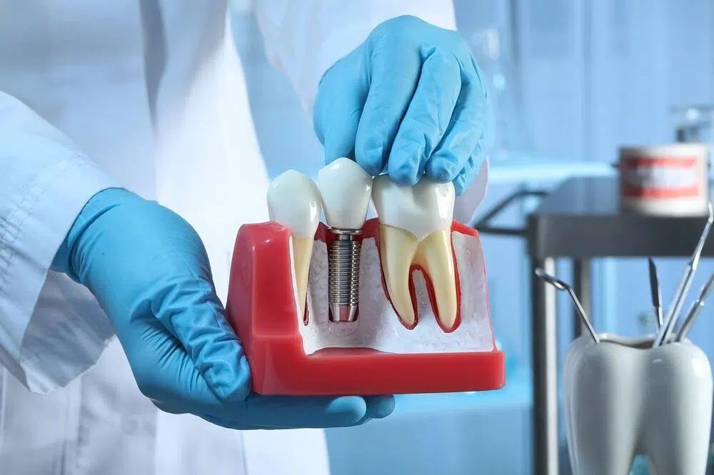 best-dental-implants-brisbane-hashtag-dentist-big-0