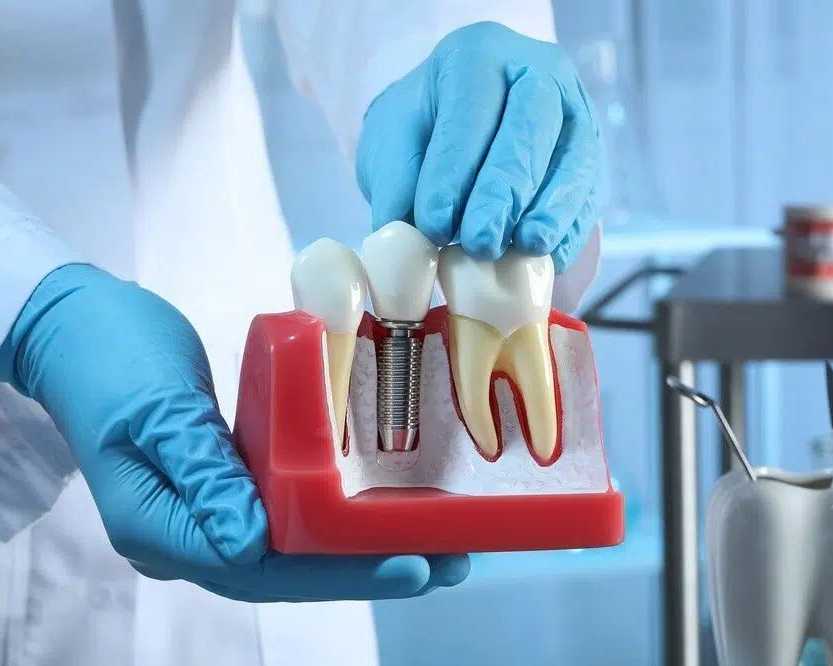 best-dental-implants-brisbane-hashtag-dentist
