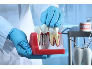 best-dental-implants-brisbane-hashtag-dentist-small-0
