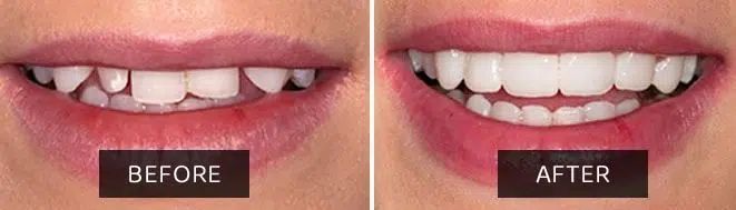 composite-veneers-brisbane-hashtag-dentist-big-0