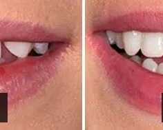 composite-veneers-brisbane-hashtag-dentist