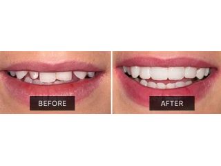 composite-veneers-brisbane-hashtag-dentist-small-0