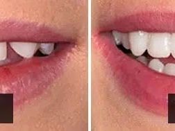 composite-veneers-brisbane-hashtag-dentist