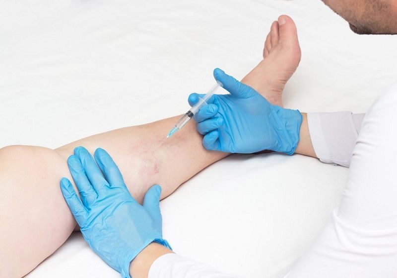 does-spider-vein-removal-really-work-big-0
