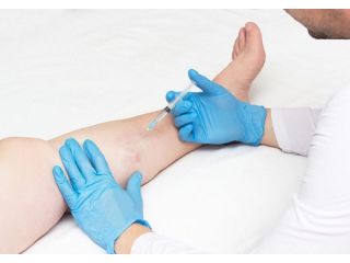 does-spider-vein-removal-really-work-small-0