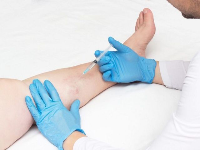 does-spider-vein-removal-really-work