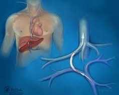 tips-procedure-radiology-for-liver-management