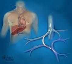 tips-procedure-radiology-for-liver-management-big-0