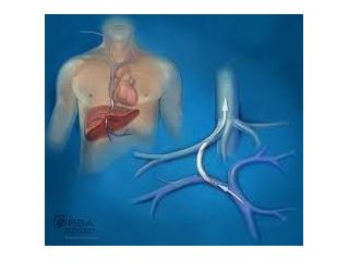 tips-procedure-radiology-for-liver-management-small-0