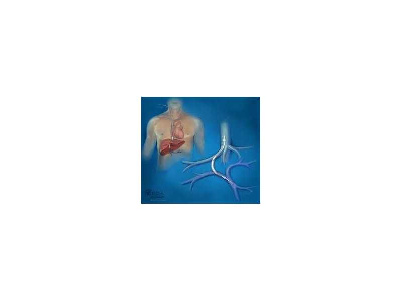 tips-procedure-radiology-for-liver-management-small-0