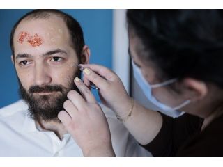 reliable-wart-infection-care-treatment-in-nyc-small-0