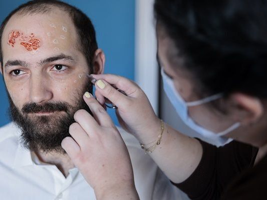 reliable-wart-infection-care-treatment-in-nyc