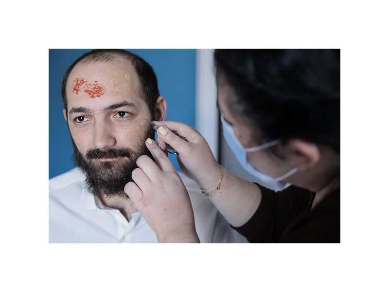 reliable-wart-infection-care-treatment-in-nyc-small-0