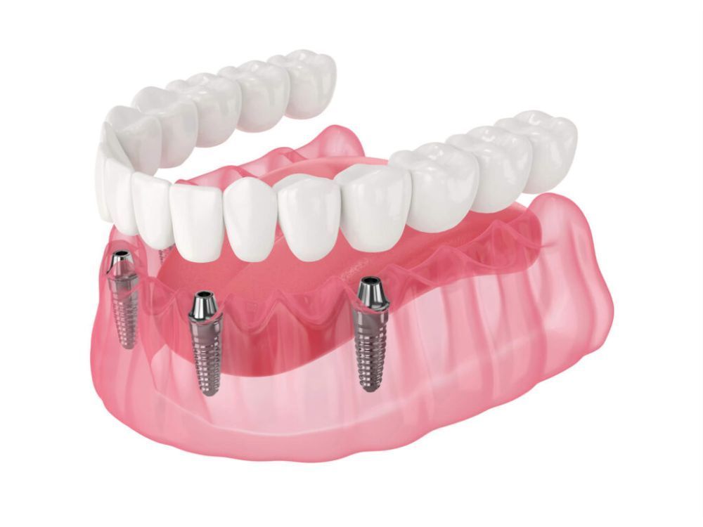 revolutionizing-smiles-all-on-x-implants-transform-overnight-big-0