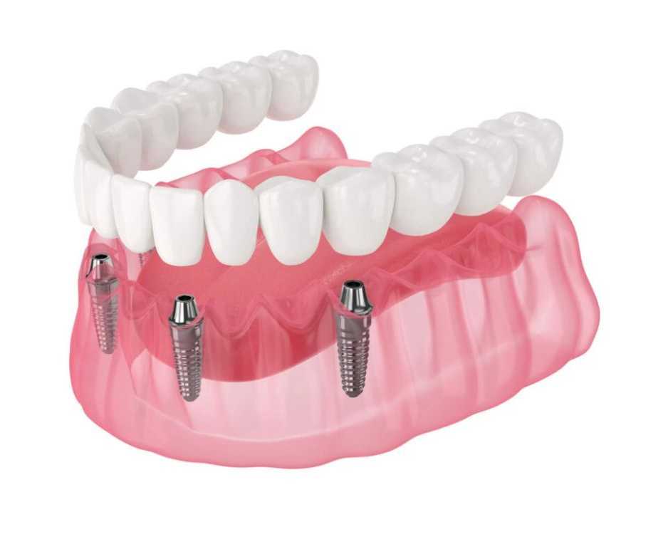 revolutionizing-smiles-all-on-x-implants-transform-overnight