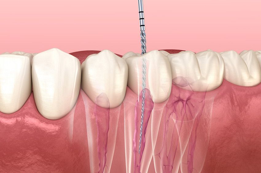 root-canal-vs-tooth-extraction-north-brunswick-big-0