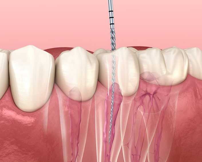 root-canal-vs-tooth-extraction-north-brunswick