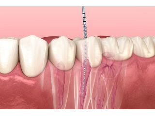 root-canal-vs-tooth-extraction-north-brunswick-small-0