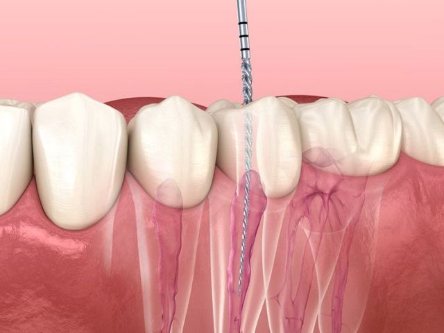 root-canal-vs-tooth-extraction-north-brunswick