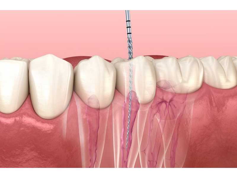 root-canal-vs-tooth-extraction-north-brunswick-small-0