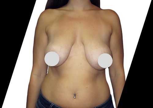 what-should-i-expect-during-a-breast-lift-big-0