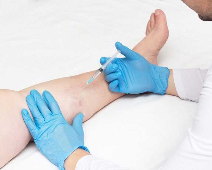 the-best-vein-treatment-specialists