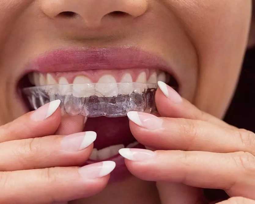 what-are-inlays-and-onlays-in-dental-restoration