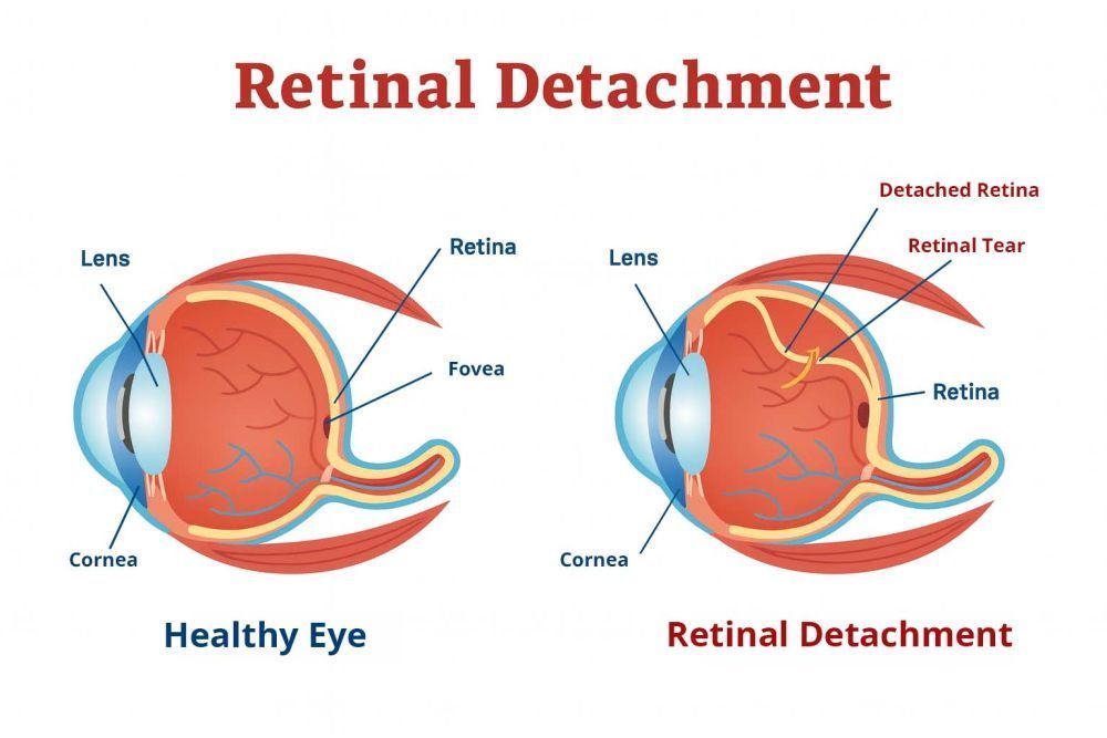 understanding-retinal-detachment-tears-for-early-treatment-big-0