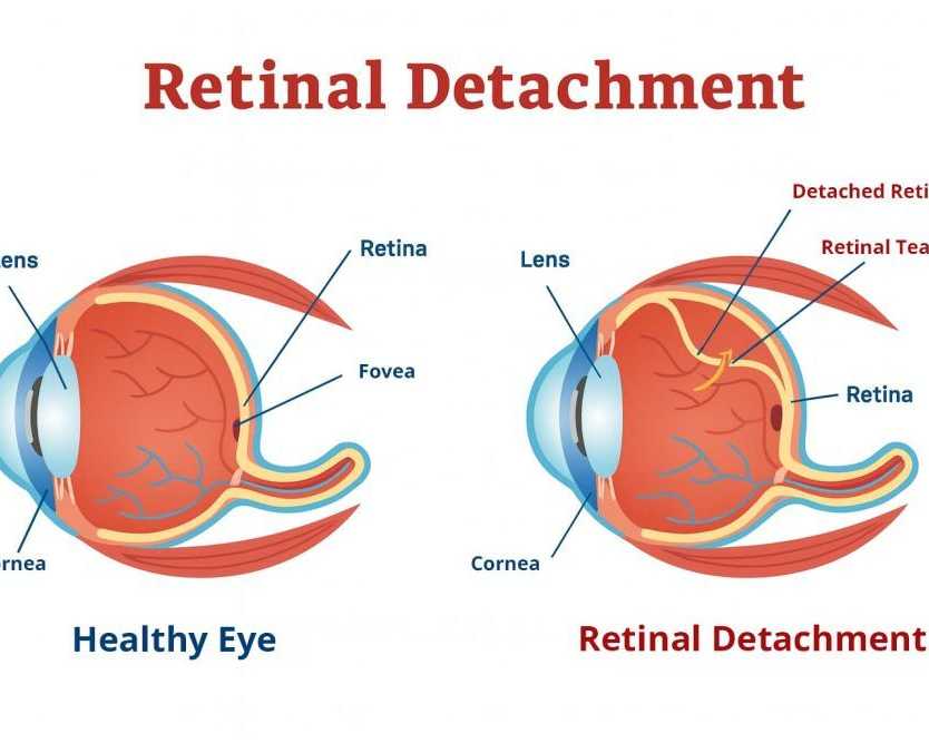 understanding-retinal-detachment-tears-for-early-treatment