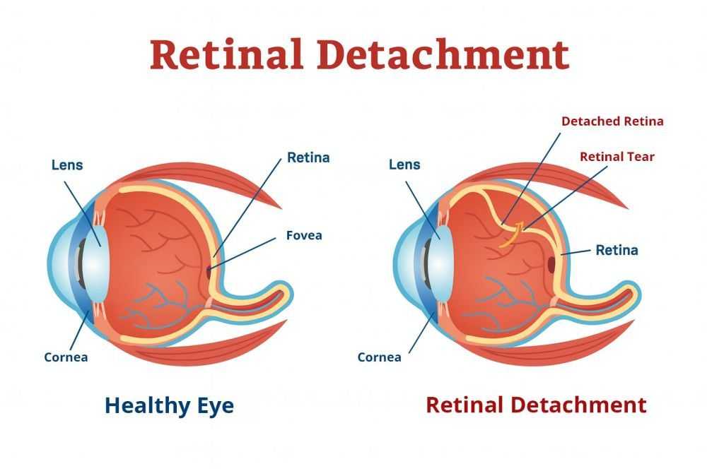 understanding-retinal-detachment-tears-for-early-treatment-big-0