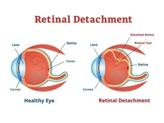 understanding-retinal-detachment-tears-for-early-treatment-small-0