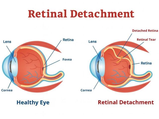 understanding-retinal-detachment-tears-for-early-treatment