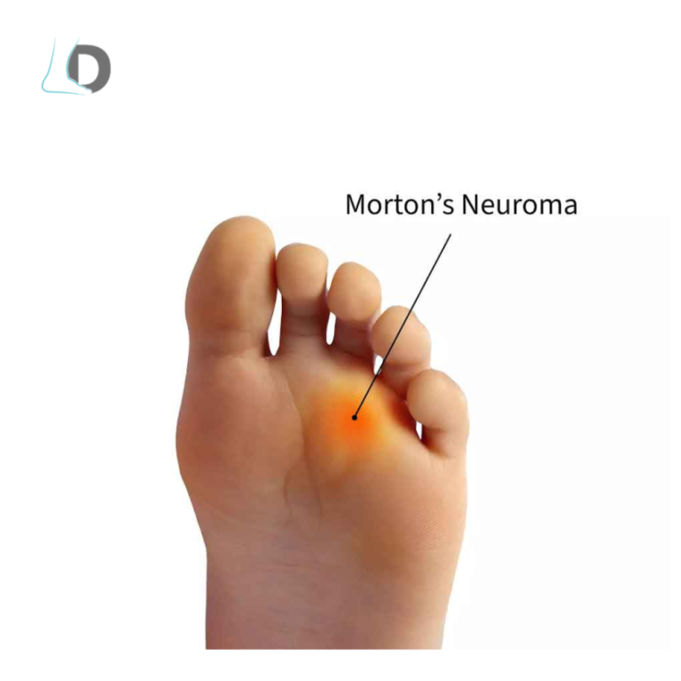 effective-treatment-for-neuromas-to-relieve-foot-pain-big-0