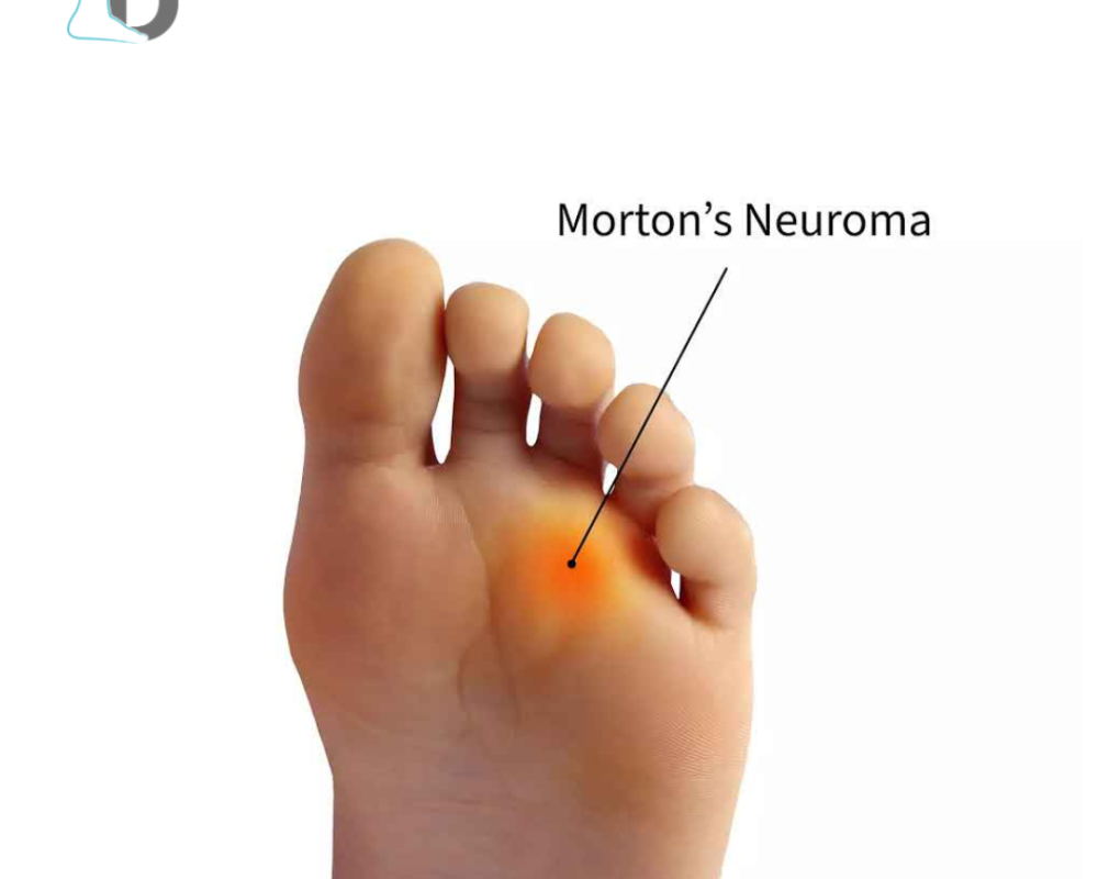 effective-treatment-for-neuromas-to-relieve-foot-pain