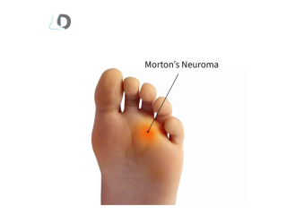 effective-treatment-for-neuromas-to-relieve-foot-pain-small-0