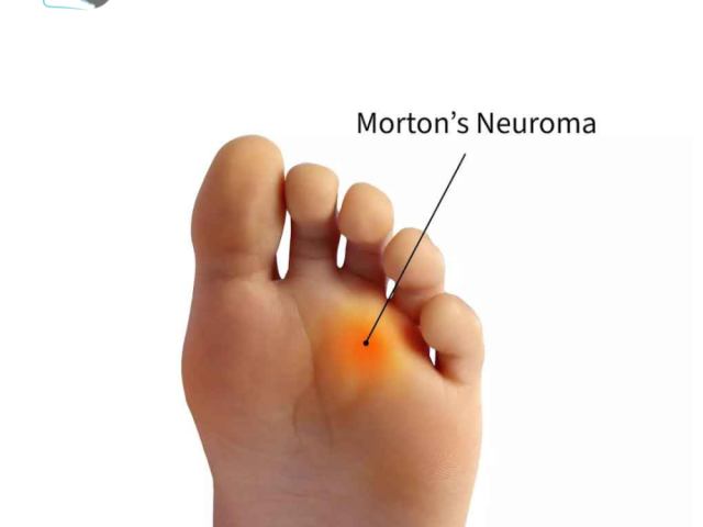 effective-treatment-for-neuromas-to-relieve-foot-pain