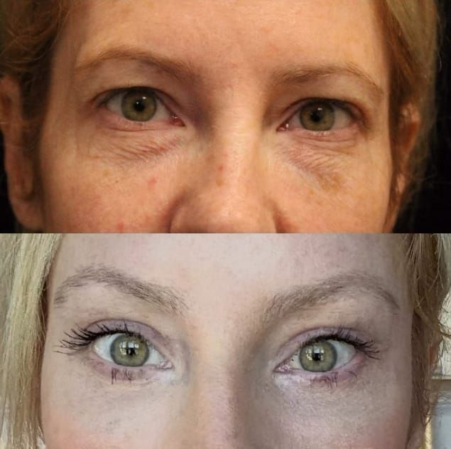 refresh-your-eyes-with-blepharoplasty-raleigh-nc-big-0
