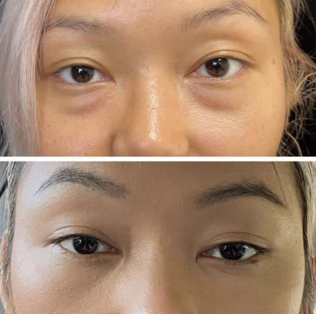 refresh-your-eyes-with-blepharoplasty-raleigh-nc-big-1